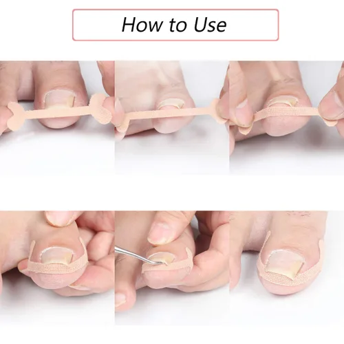 Miniatura 4 de EBANKU Tiras de tratamiento de uñas encarnadas, 20 piezas de parche de corrección de uñas de los pies, parche elástico, corrector de pedicura