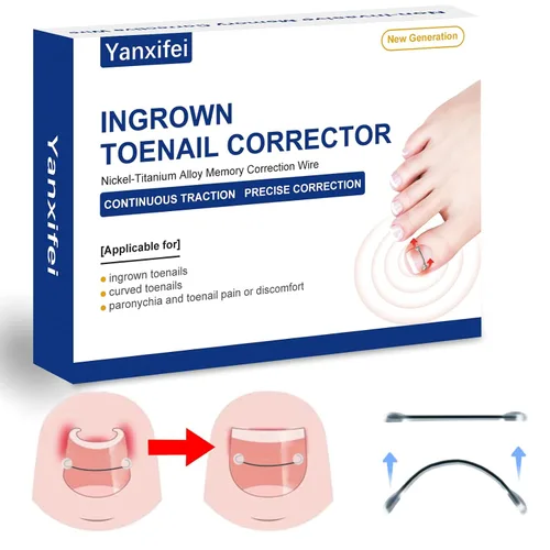 Miniatura 8 de Corrector de uñas encarnadas de nitinol dual, tratamiento de uñas encarnadas, enderezador de uñas curvas, kit de eliminación de uñas encarnadas