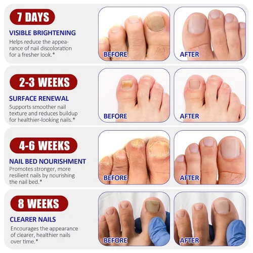 Miniatura 5 de Parches de uñas, 32 parches para el cuidado de las uñas de los pies para uñas secas, débiles y agrietadas, uñas profundamente hidratantes, protegen