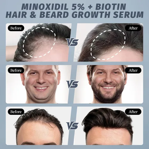 Miniatura 5 de Spray de minoxidil al 5% para el crecimiento del cabello, hombres y mujeres, tratamiento para adelgazamiento y retroceso de la línea del cabello