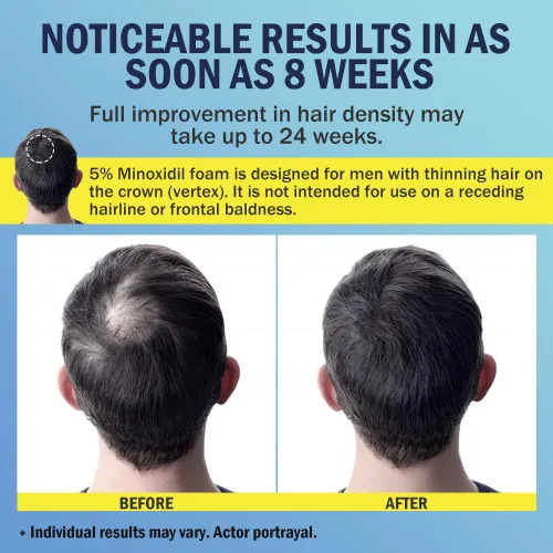 Miniatura 4 de Ruahouine Espuma de minoxidil al 5% para el crecimiento del cabello, tratamiento tópico de pérdida de cabello para hombres para que vuelvan a crecer