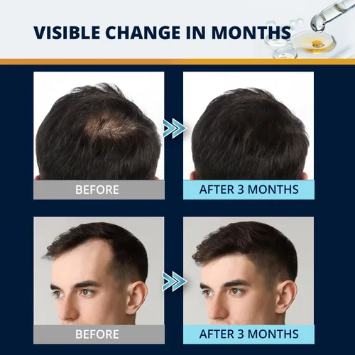 Miniatura 4 de Kit de crecimiento de cabello y barba de minoxidil al 5%: suero tópico de minoxidil extra fuerte para el crecimiento del cabello para adelgazar