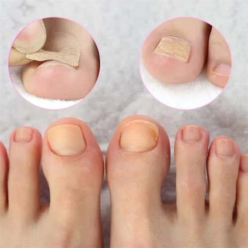 Miniatura 8 de Parche de corrección de uñas encarnadas, 50 calcomanías de uñas encarnadas sin pegamento para uñas encarnadas curvadas para el cuidado de los pies