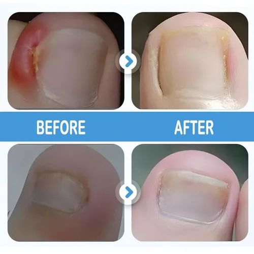 Miniatura 3 de Juego profesional de uñas encarnadas con tiras transpirables de uñas encarnadas, tiras correctoras de uñas de los pies, parche corrector de uñas