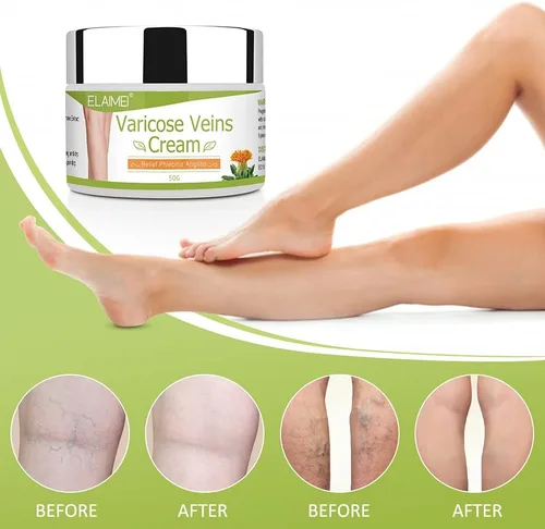 Miniatura 5 de Crema para venas varicosas para piernas – Mejora la circulación sanguínea, reduce las venas de araña y la pesadez, alivia la flebitis venas Trata