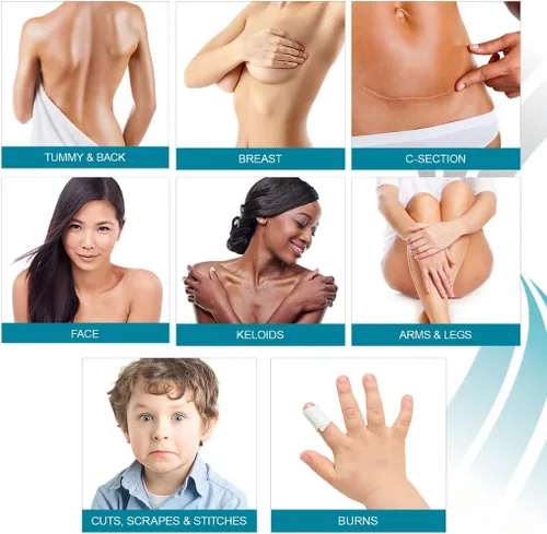 Miniatura 6 de NewGel - Cinta profesional de silicona avanzada para tratamiento de cicatrices por MyNewGel, ultra gruesa, para abdomen, sección C, queloides