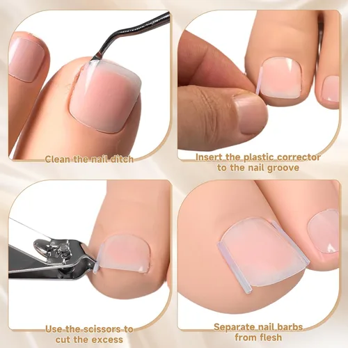 Miniatura 6 de Kit corrector de uñas encarnadas de 201 piezas con tiras de corrección transpirables, parches de uñas curvas, herramientas levantadoras de uñas