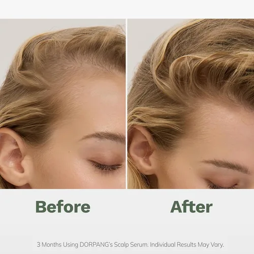 Miniatura 3 de Suero para el cuero cabelludo para la pérdida de cabello: reduce la caída del cabello y mejora la salud del cuero cabelludo, ayuda con los signos