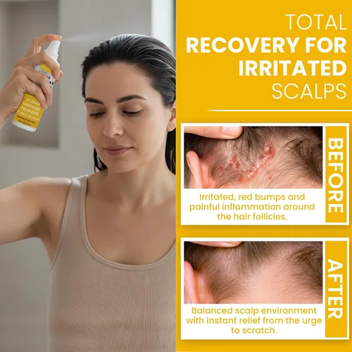Miniatura 4 de Psoriasis Scalp Spray Tratamiento de psoriasis y caspa para infecciones por levaduras del cuero cabelludo, brotes de psoriasis y foliculitis
