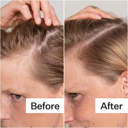 Miniatura 3 de Act+ Acre Exfoliante de ácido salicílico procesado en frío Para escamas sueltas, exceso de aceite, acumulación de cuero cabelludo Ácido