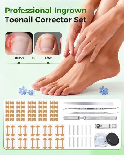Miniatura 5 de Juego de corrector de uñas encarnadas con tiras correctoras, kit de eliminación de uñas encarnadas, parche corrector, herramientas de pedicura