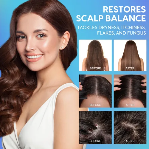 Miniatura 2 de Acondicionador para la caspa para el cabello y el cuero cabelludo seco: hidratación profunda y alivio calmante con ingredientes naturales, calma