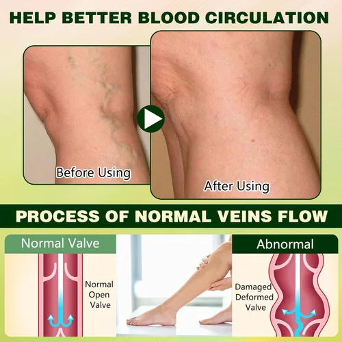 Miniatura 4 de Crema profesional para la circulación de piernas, crema calmante para piernas Fluid Ease para aliviar el edema para piernas y pies, reduce