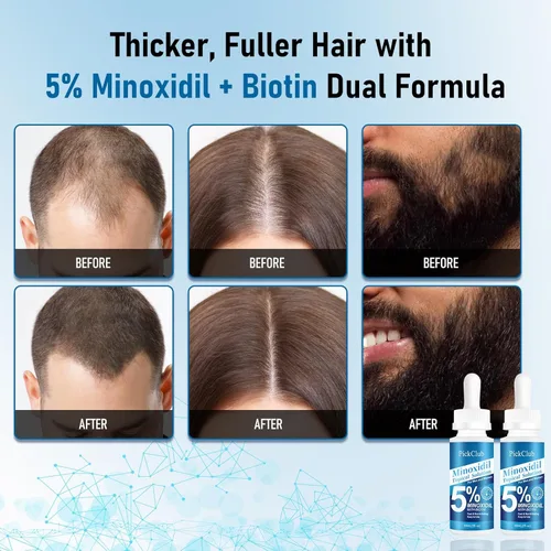 Miniatura 2 de 5% de minoxidil con biotina para hombres y mujeres – Suero para el crecimiento del cabello y la barba, unisex, suave, paquete de 2 (total 4.06 fl oz)
