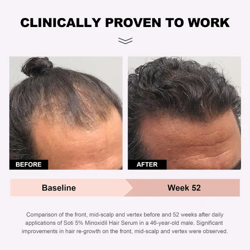 Miniatura 3 de Suero tópico para el crecimiento del cabello de minoxidil al 5% para hombres y mujeres, suero para el crecimiento del cabello para la pérdida