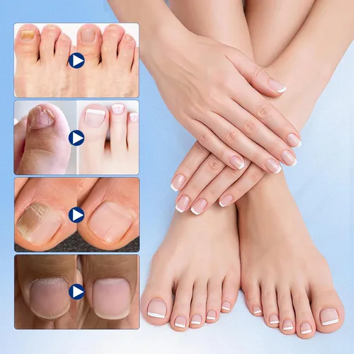 Miniatura 6 de Tratamiento de hongos en las uñas de los pies extra fuerte – 21 parches de uñas de hongos, parches de reparación de uñas, 8 horas de adherencia