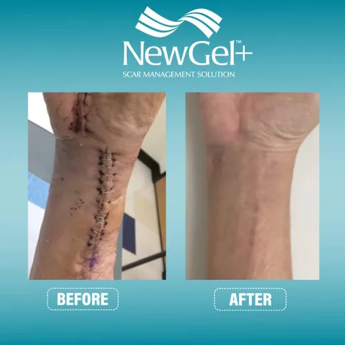 Miniatura 9 de NewGel - Cinta profesional de silicona avanzada para tratamiento de cicatrices por MyNewGel, ultra gruesa, para abdomen, sección C, queloides