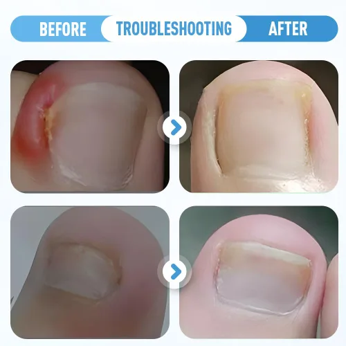 Miniatura 5 de Juego profesional de corrector de uñas encarnadas, nuevo juego profesional de uñas encarnadas con tiras transpirables de uñas encarnadas, lima sin