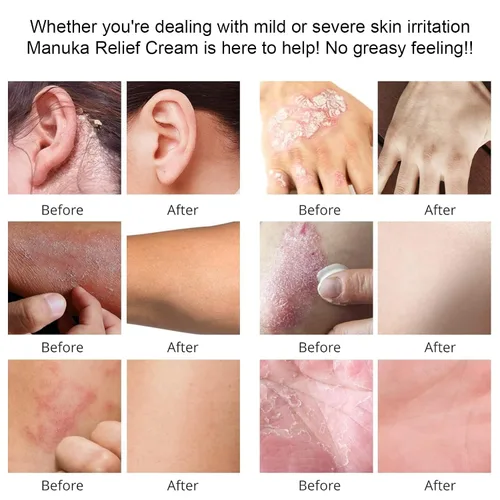 Miniatura 7 de Crema orgánica de loción de miel de manuka con avena coloidal, hidratante calmante para piel seca, para alivio, eccema de manos y cuerpo, psoriasis