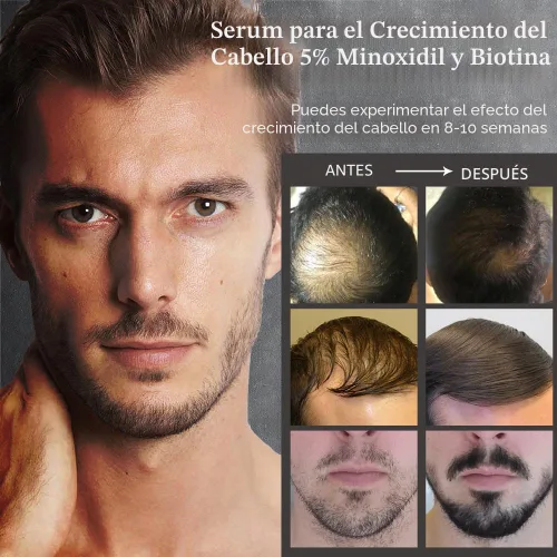 Miniatura 5 de Ruahouine Tratamiento para el crecimiento del cabello para más grueso, 5% de minoxidil biotina aceite de suero para el crecimiento del cabello