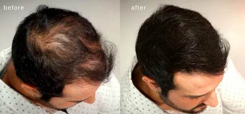 Miniatura 3 de Fibras capilares voluminizadoras con queratina real para adelgazar el cabello/pérdida de cabello – Dermatológicamente probado y certificado