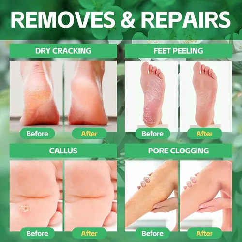 Miniatura 2 de Remojo de pies de pedicura, baño de pies de spa, kit de pedicura, baño de pies de burbujas para pies agrietados y cansados y secos, pies de atletas
