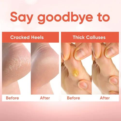 Miniatura 5 de Máscara exfoliante para pies - Máscara para pies con piel suave como la de un bebé - Elimina la piel muerta, pies secos, agrietados y callos, spa
