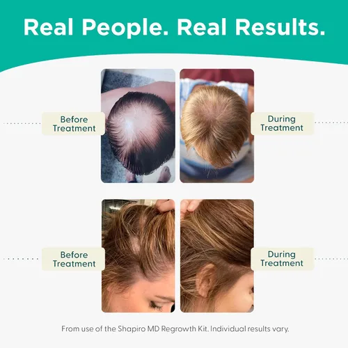 Miniatura 5 de Shapiro MD Hair Growth Experts Champú y Acondicionador contra la Caída del Cabello, Fórmula Vegana Anti-DHT para Cabello Adelgazado Desarrollada por
