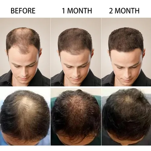 Miniatura 7 de Crema de masaje de cuero cabelludo de minoxidil al 5 % para el crecimiento del cabello, crema de minoxidil profesional, rápido crecimiento y 2 pzas