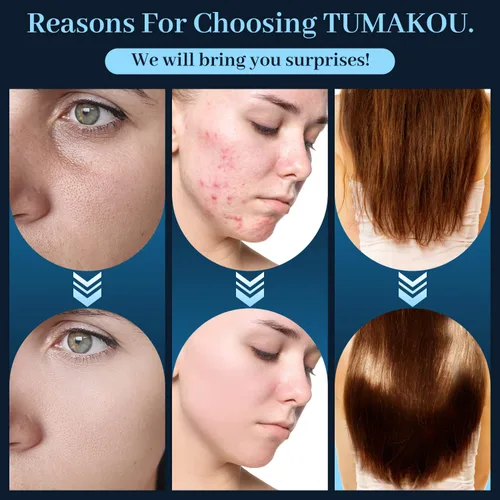 Miniatura 5 de TUMAKOU - Varita facial de alta frecuencia, portátil de mano azul de alta frecuencia, 4 tubos de vidrio azul diferentes para la piel