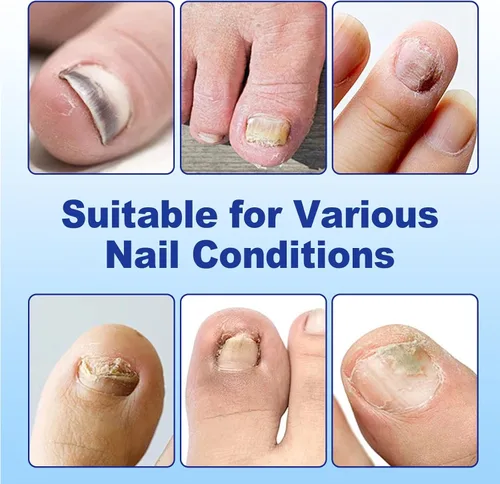 Miniatura 5 de Parches de uñas para uñas de los pies, paquete de 2, calcomanías para uñas de los pies, parches de uñas nocturnas de 8 horas para uñas grandes