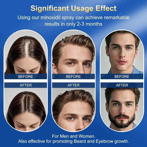 Miniatura 7 de Spray de minoxidil al 5% para hombres, suministrado con un aplicador de minoxidil, impregnado con biotina, tratamiento para el crecimiento