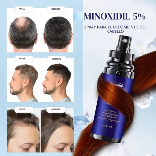 Miniatura 4 de Crecimiento del cabello de minoxidil al 5% para hombres y mujeres: paquete de 2 sueros de tratamiento de pérdida de cabello con minoxidil extra