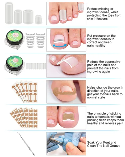 Miniatura 4 de Kit de eliminación de uñas encarnadas, tratamiento de uñas encarnadas, herramientas correctoras de uñas encarnadas vienen con soportes para uñas