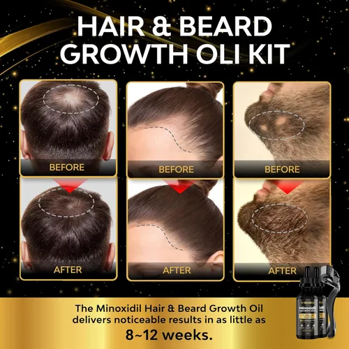Miniatura 2 de Beaueli Kit de crecimiento de barba de Minoxidil para hombres y mujeres, tratamientos para la pérdida de cabello y el crecimiento del cabello