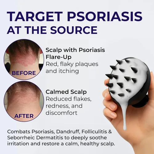 Miniatura 2 de Champú para Psoriasis Anti Caspa - Champú medicado para el tratamiento de la caspa, escamas, dermatitis seborreica y folikulitis - Solución