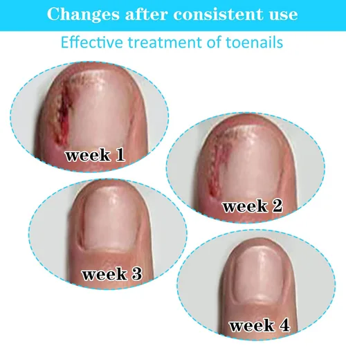 Miniatura 6 de (50+1) Juego de tratamiento corrector de uñas encarnadas, kit profesional de eliminación de uñas encarnadas sin dolor con levantador de uñas