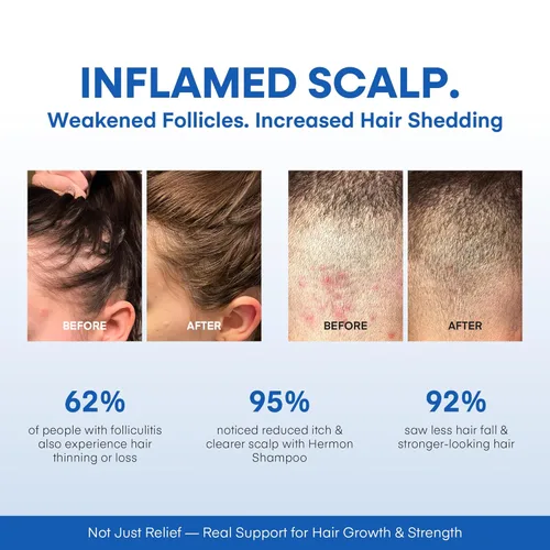 Miniatura 6 de Hermon Champú para foliculitis para el cuero cabelludo con picazón: psoriasis, caspa, dermatitis seborreica y biotina - Alivia Exfolia Reactiva