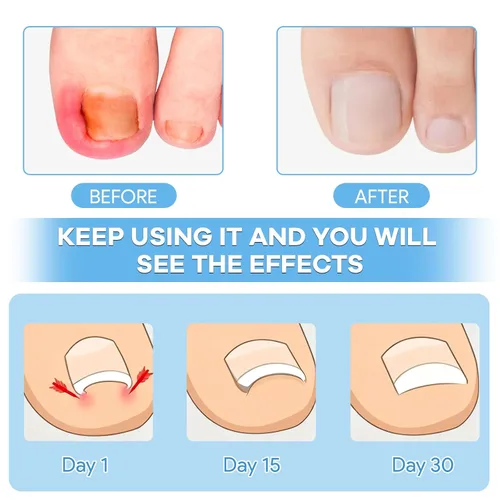Miniatura 2 de Kit de eliminación de uñas encarnadas con tiras de uñas encarnadas, parche corrector de uñas curvas, lima de uñas y herramientas de pedicura
