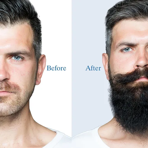 Miniatura 5 de Espuma de minoxidil al 5% para el crecimiento del cabello y la barba de hombres, solución tópica ligera recomendada por dermatólogos, tratamiento