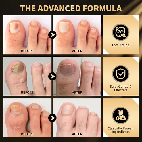 Miniatura 7 de Bolígrafo extra fuerte para tratamiento de hongos en las uñas de los pies y dedos dañados, extractos de plantas naturales más puros, parches