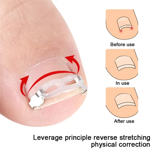 Miniatura 2 de Juego de herramientas de corrección de uñas encarnadas, 2 clips de inserción de acero inoxidable para tratamiento de uñas encarnadas, tiras