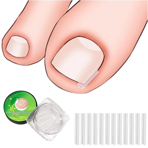 Miniatura 3 de (30+2) Kit de tratamiento de corrección de uñas encarnadas, 30 tiras correctoras de uñas encarnadas, herramienta de pedicura de uñas encarnadas