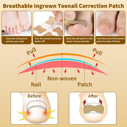 Miniatura 3 de Juego de corrector de uñas encarnadas con tiras correctoras y lima sin dolor, kit profesional de eliminación de uñas encarnadas con herramienta