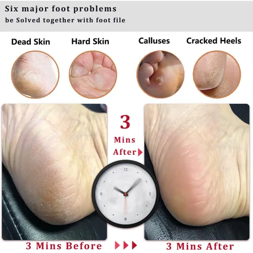Miniatura 3 de LEKESI - Lima de piedra pómez para retirar callosidades y piel muerta de los pies, herramienta para exfoliar y masajear los pies, se usa con pies