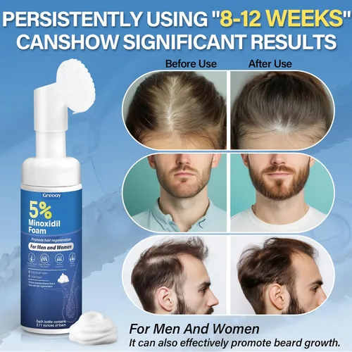 Miniatura 2 de Espuma de crecimiento del cabello de minoxidil al 5 % para hombres y mujeres, adecuada para adelgazamiento del cabello, línea capilar y pérdida