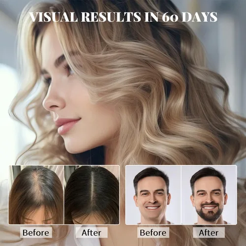 Miniatura 4 de Spray de minoxidil al 5% para hombres y mujeres, suero para el crecimiento del cabello con biotina para reducir la pérdida de cabello, estimular