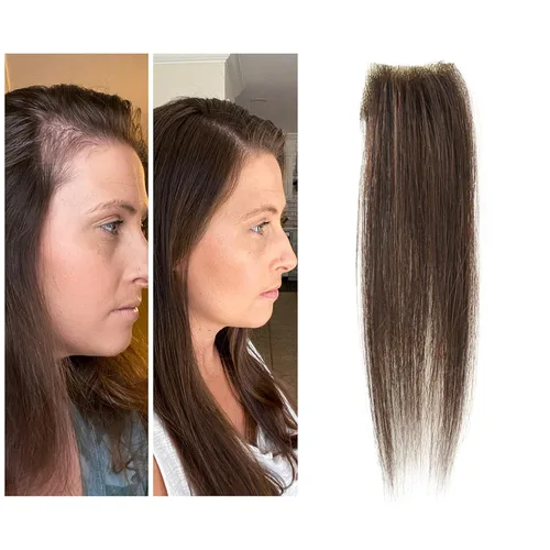 Reemplazo de cabello humano con cicatrices, quemaduras accidentales sin vello para hombres y mujeres, pérdida de línea de cabello, cinta recta de