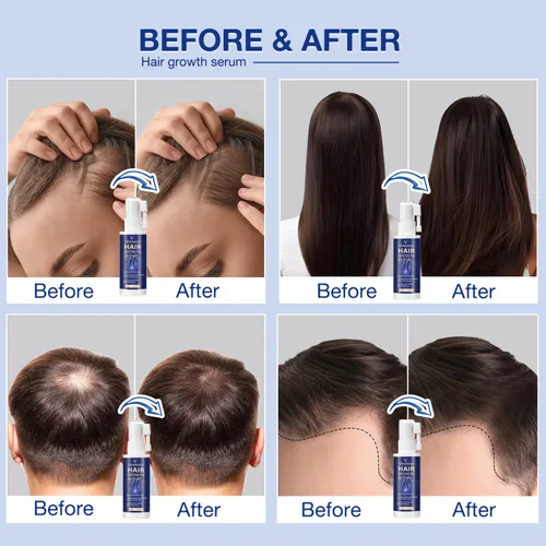Miniatura 2 de VENANOCI Spray de aceite para el crecimiento del cabello: suero natural para el crecimiento del cabello con romero, biotina, tratamiento contra