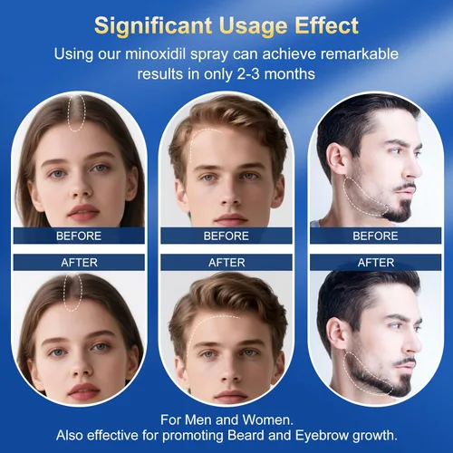 Miniatura 4 de 5% de minoxidil para hombres y mujeres, suero para el crecimiento del cabello y tratamiento de crecimiento del cabello, extra fuerte con biotina